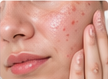 Acne treatment and dermatology care