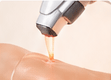 Laser hair removal treatment
