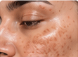 Melasma and pigmentation treatment